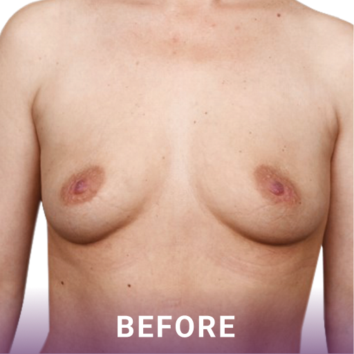 Mid shot of a woman's breasts before breast reconstruction surgery.