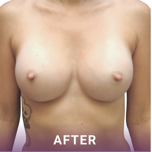 Mid shot of a woman's breasts after breast augmentation surgery