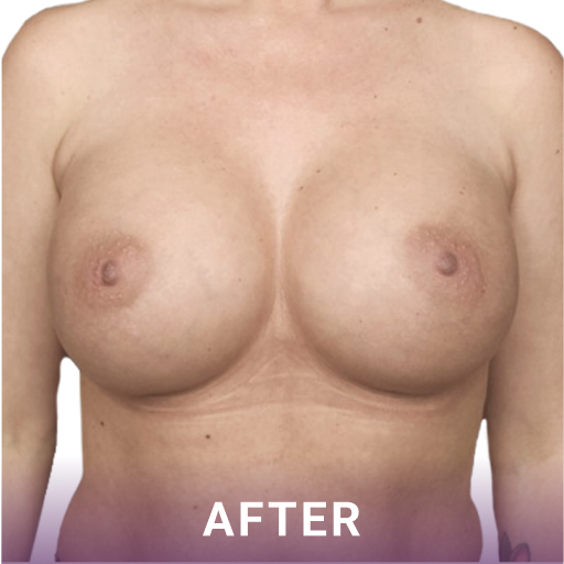 Mid shot of a womans breast's after breast reconstruction surgery.