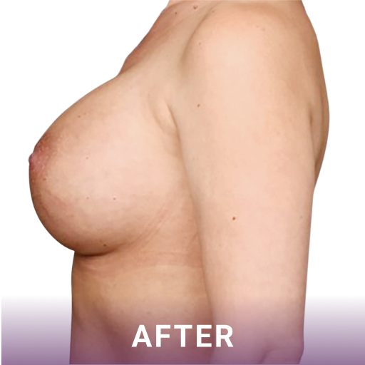 Side shot of a woman's breasts after breast reconstruction surgery.