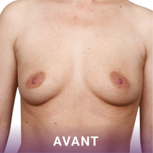 Plan moyen des seins d'une femme avant la chirurgie de reconstruction mammaire.