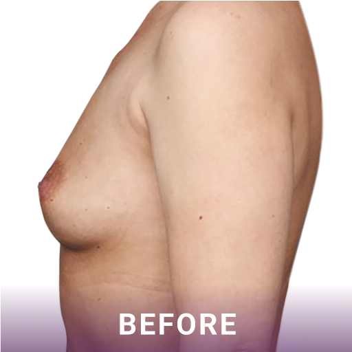 Side shot of a woman's breasts before breast reconstruction surgery.