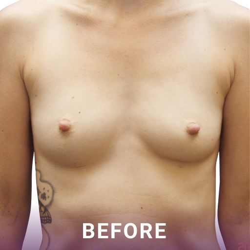 Mid shot of a woman's breasts before breast augmentation surgery