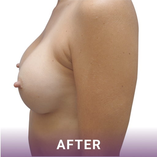 Side shot of a woman's breasts after breast augmentation surgery
