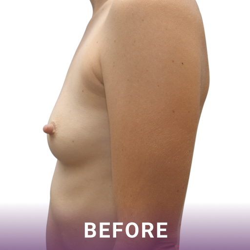 Side shot of a woman's breasts before breast augmentation surgery