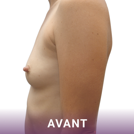 Plan latéral des seins d'une femme avant la chirurgie d'augmentation mammaire