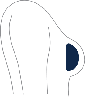 Breast Augmentation diagram of NATRELLE® INSPIRA® implant