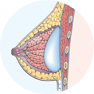 Cross section diagram, breast after subglandular augmentation
