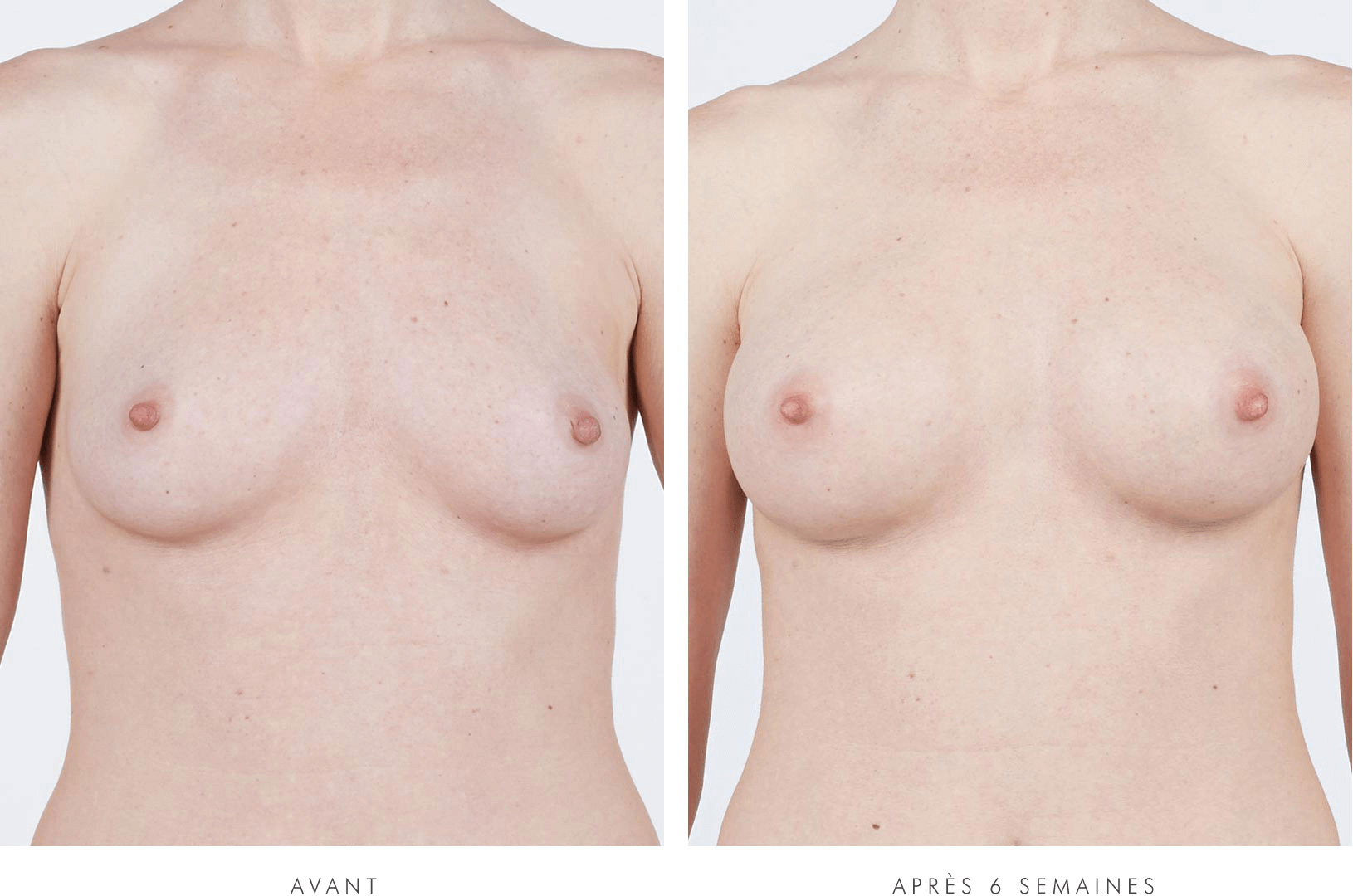 Lee, VUE DE FACE, before breast augmentation / Lee, VUE DE FACE, 6 weeks after breast augmentation with NATRELLE® INSPIRA® Style SRM-255 breast implants