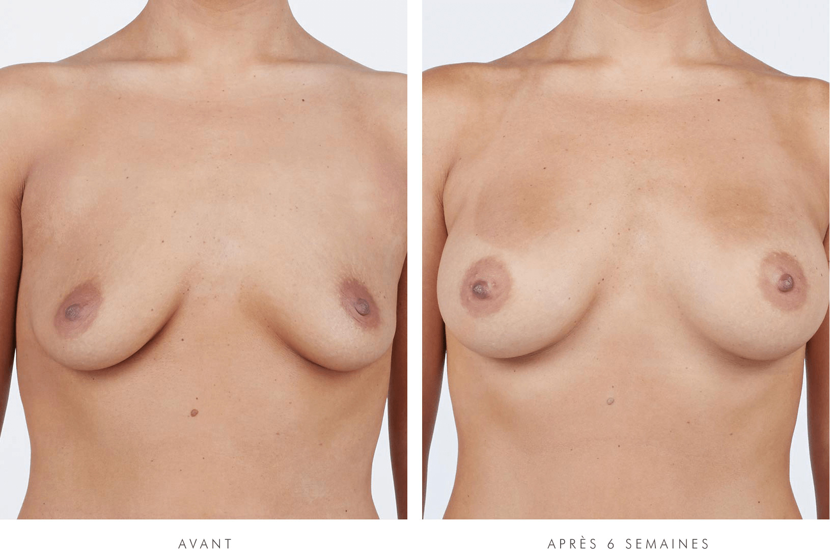 Melissa, VUE DE FACE, before breast augmentation / Melissa, VUE DE FACE, 6 weeks after breast augmentation with NATRELLE® INSPIRA® Style SRM-310 breast implants
