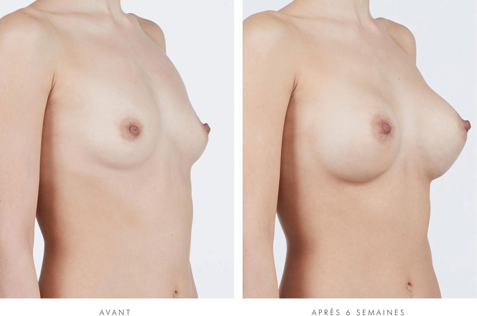 Nikki, VUE DE 3/4, before breast augmentation / Nikki, 3/4, 6 weeks after breast augmentation with NATRELLE® INSPIRA® Style SRF-415 breast implants