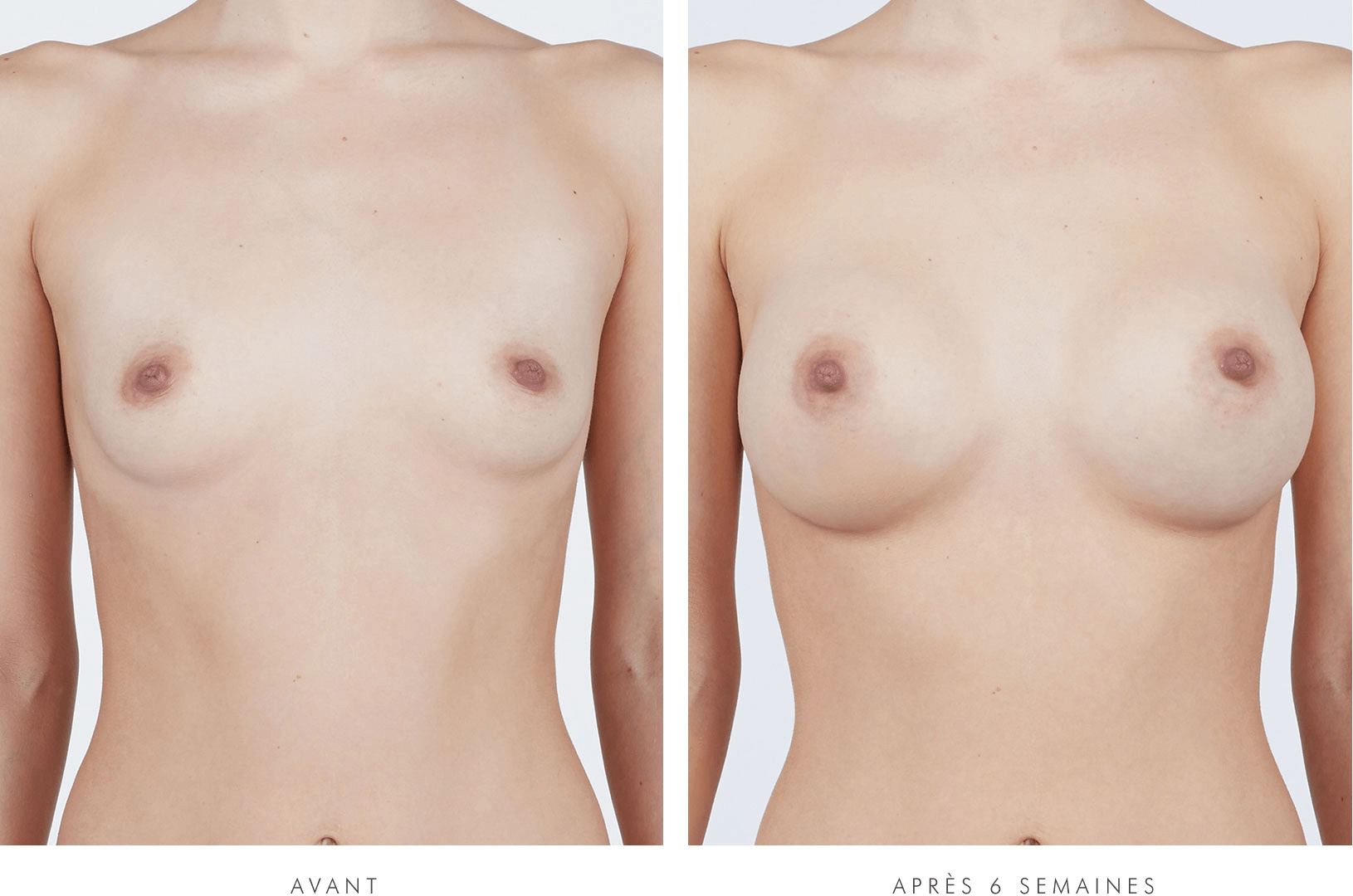 Nikki, VUE DE FACE, before breast augmentation / Nikki, VUE DE FACE, 6 weeks after breast augmentation with NATRELLE® INSPIRA® Style SRF-415 breast implants