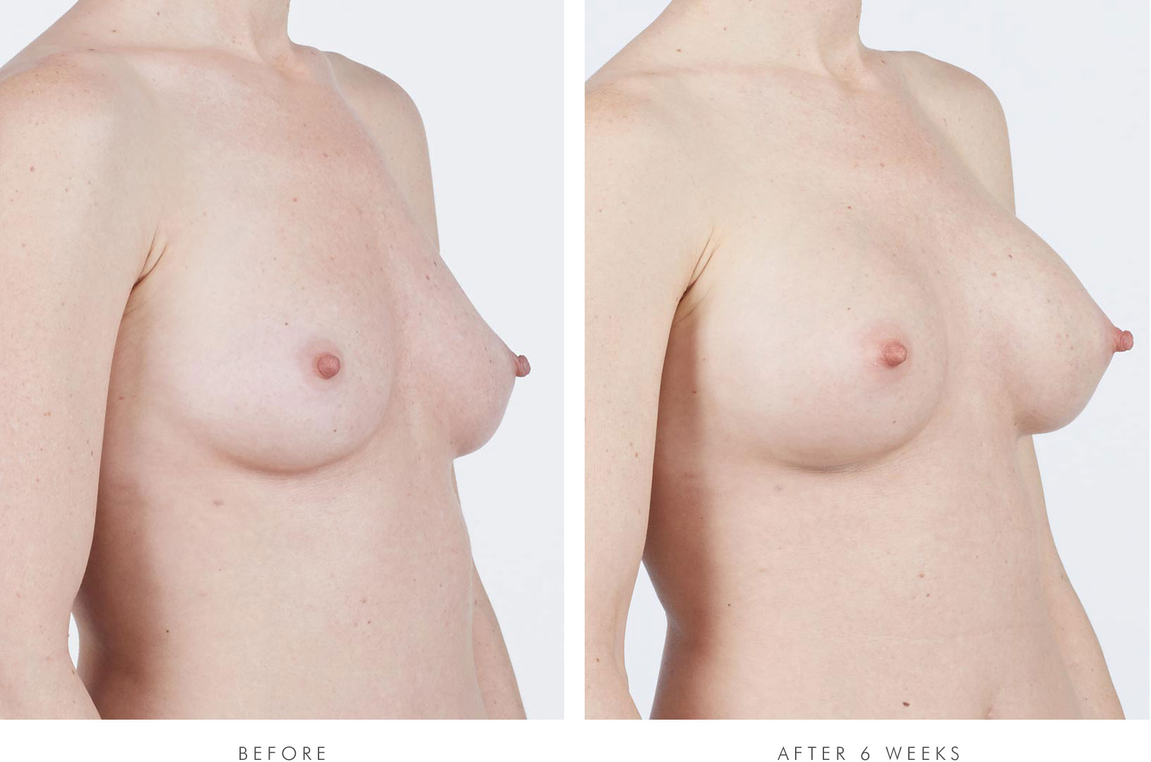 Lee, 3/4 view, before breast augmentation / Lee, 3/4 view, 6 weeks after breast augmentation with NATRELLE® INSPIRA® Style SRM-255 breast implants