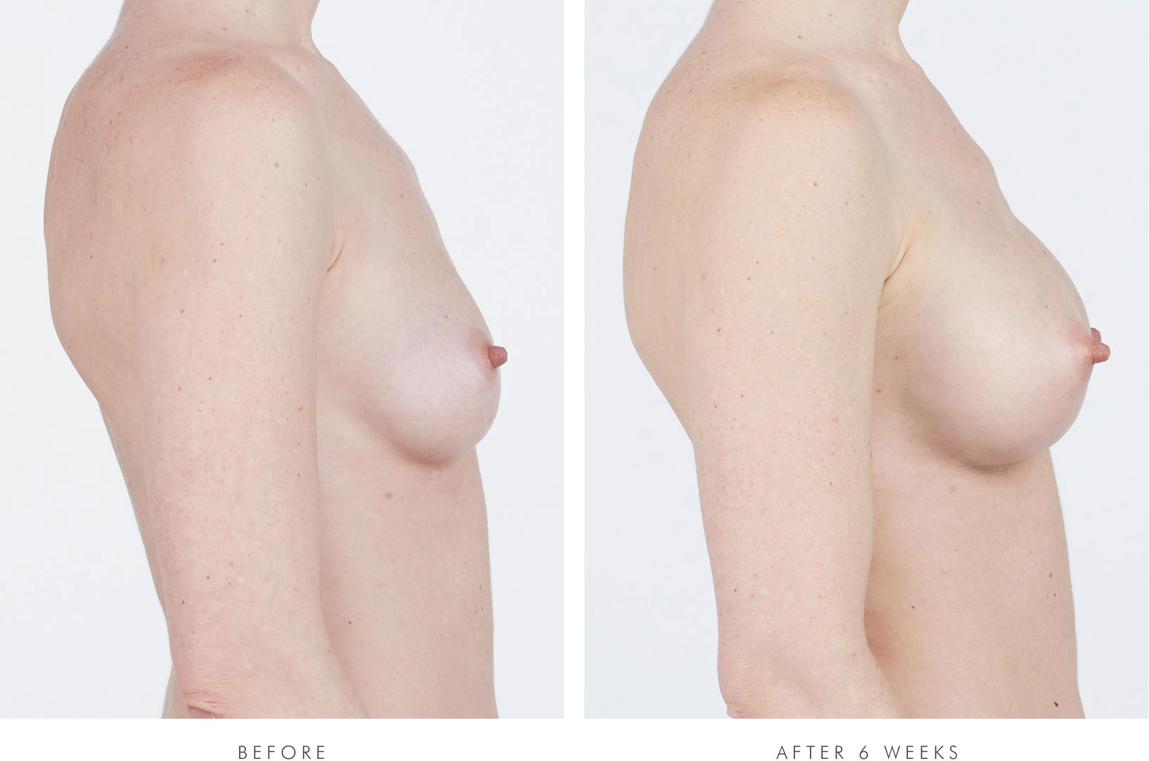Lee, side view, before breast augmentation / Lee, side view, 6 weeks after breast augmentation with NATRELLE® INSPIRA® Style SRM-255 breast implants