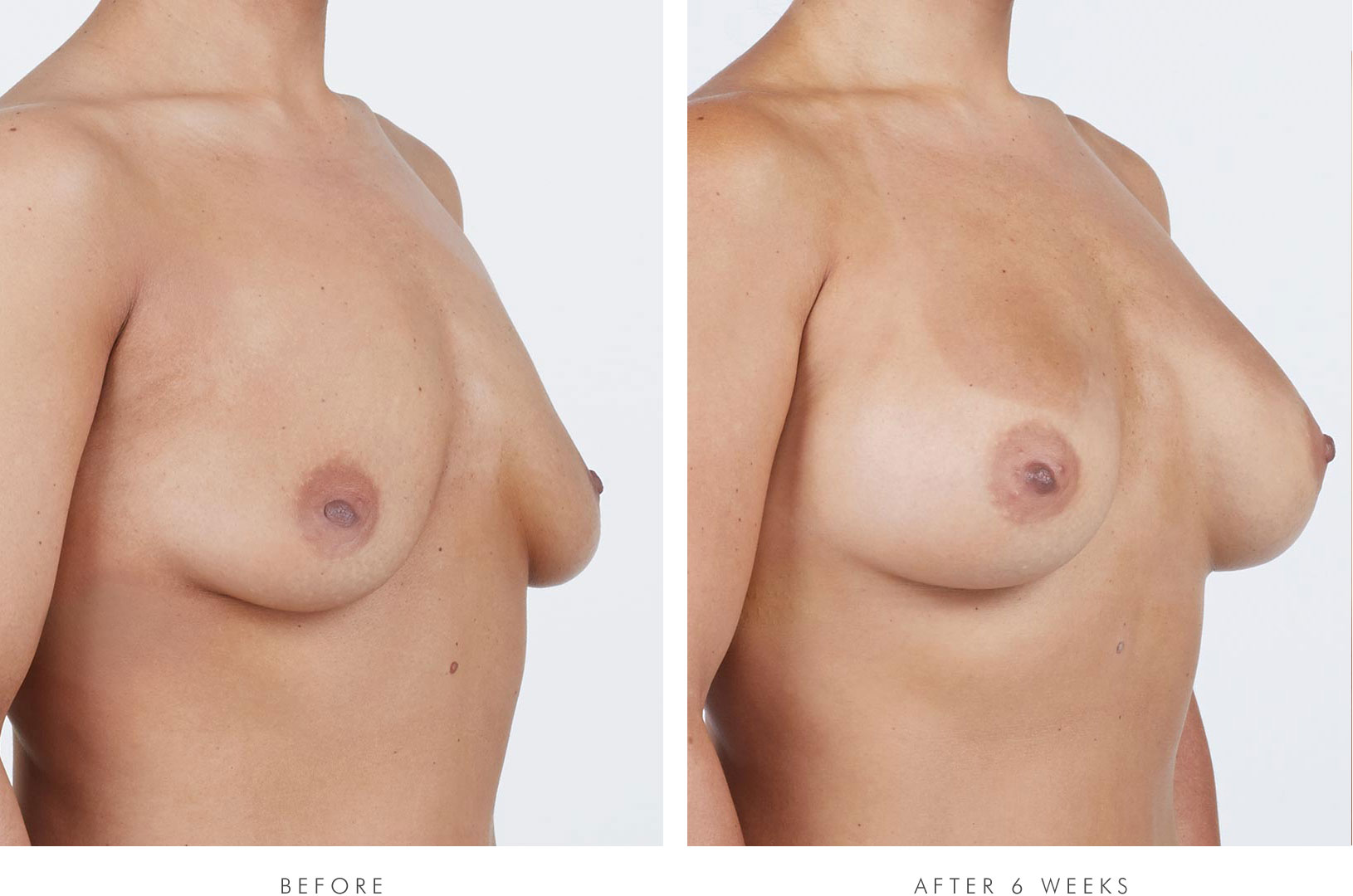 Melissa, 3/4 view, before breast augmentation / Melissa, 3/4 view, 6 weeks after breast augmentation with NATRELLE® INSPIRA® Style SRM-310 breast implants