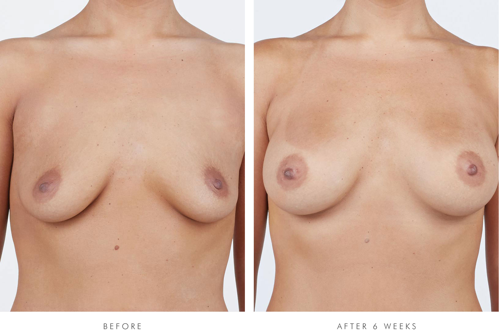 Melissa, front view, before breast augmentation / Melissa, front view, 6 weeks after breast augmentation with NATRELLE® INSPIRA® Style SRM-310 breast implants