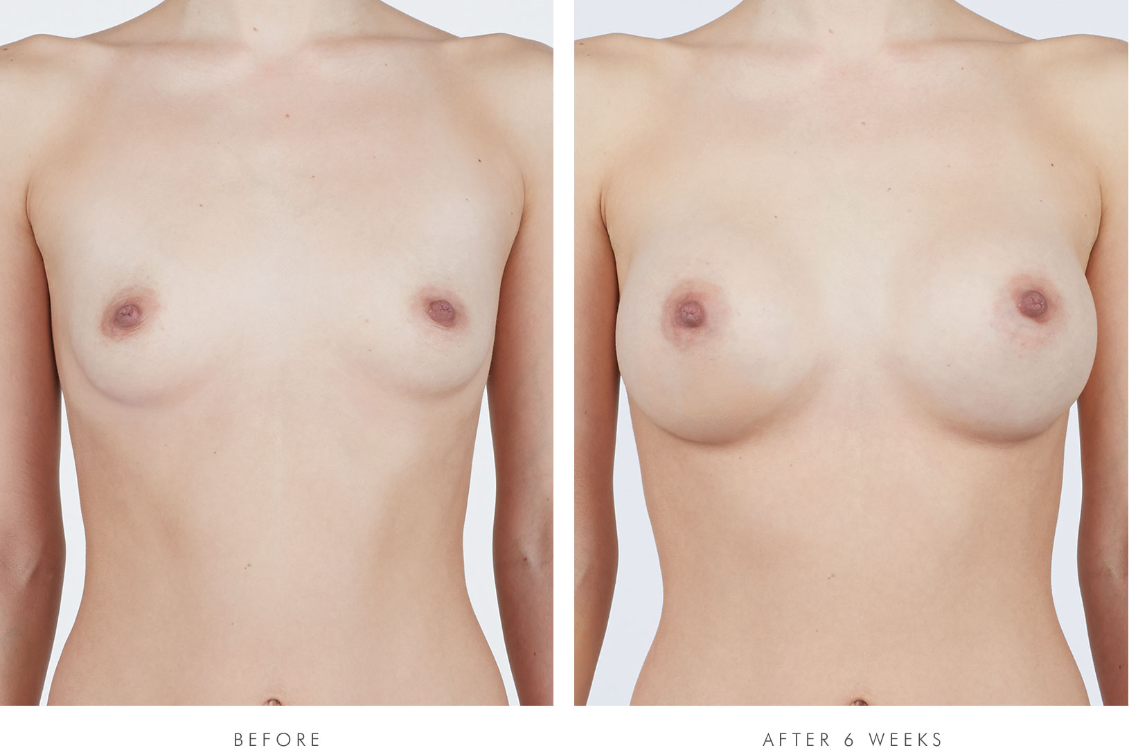 Nikki, front view, before breast augmentation / Nikki, front view, 6 weeks after breast augmentation with NATRELLE® INSPIRA® Style SRF-415 breast implants