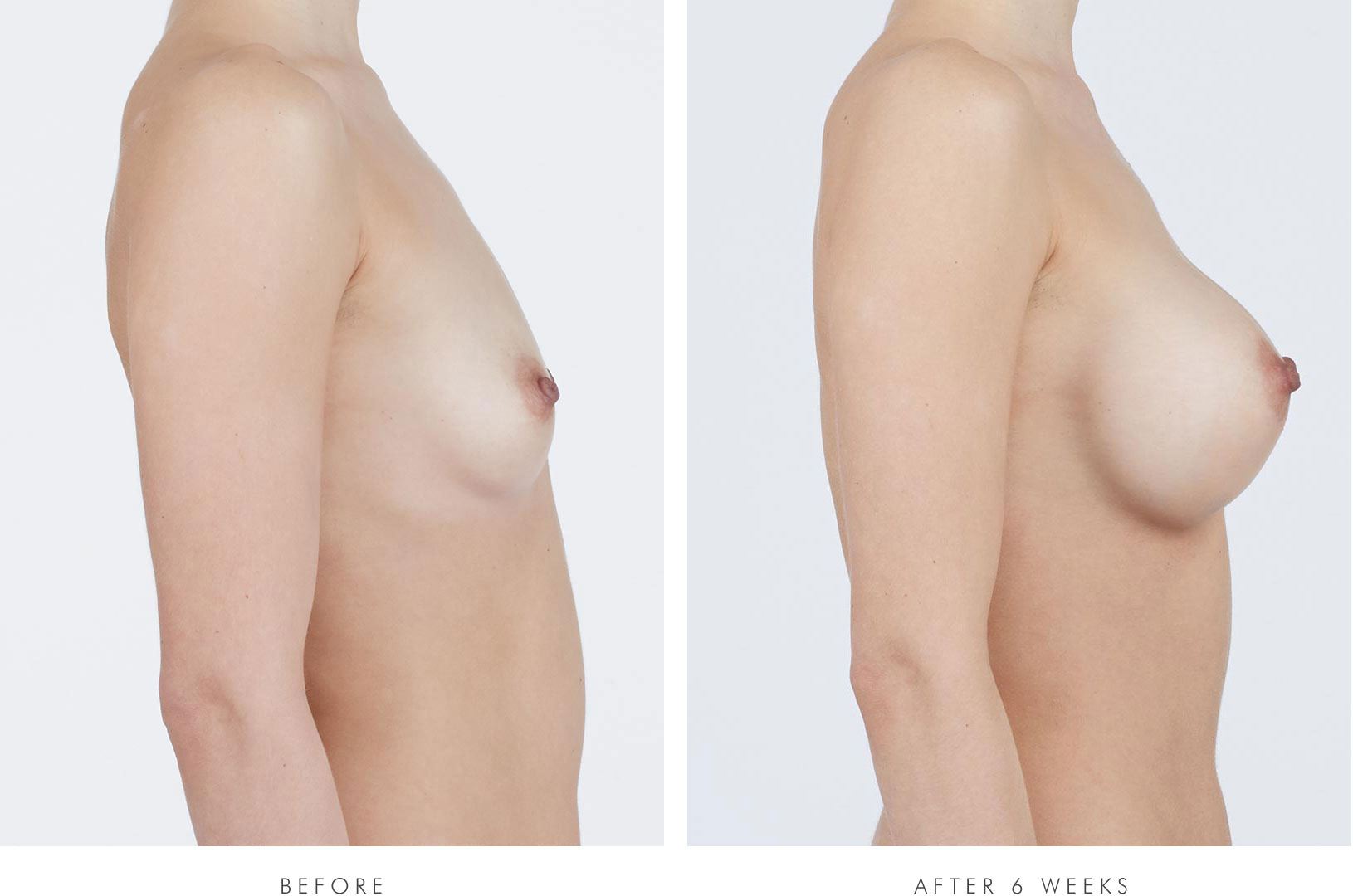 Nikki, side view, before breast augmentation / Nikki, side view, 6 weeks after breast augmentation with NATRELLE® INSPIRA® Style SRF-415 breast implants