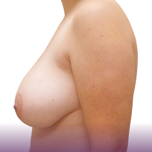 Side shot of a woman's breasts before breast augmentation surgery