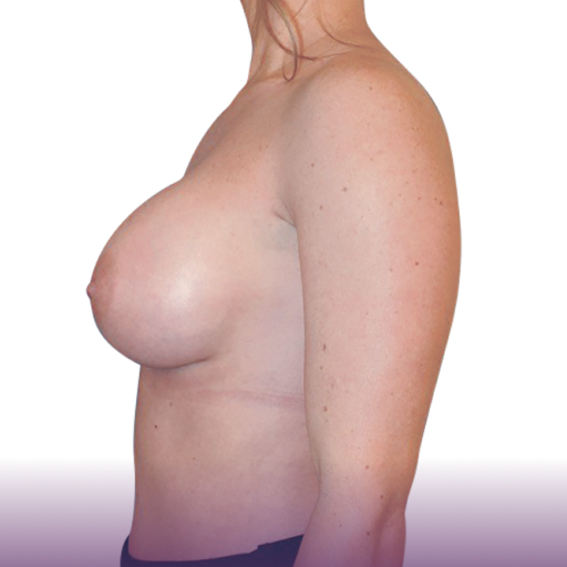 Plan latéral des seins d'une femme après une chirurgie de reconstruction mammaire.